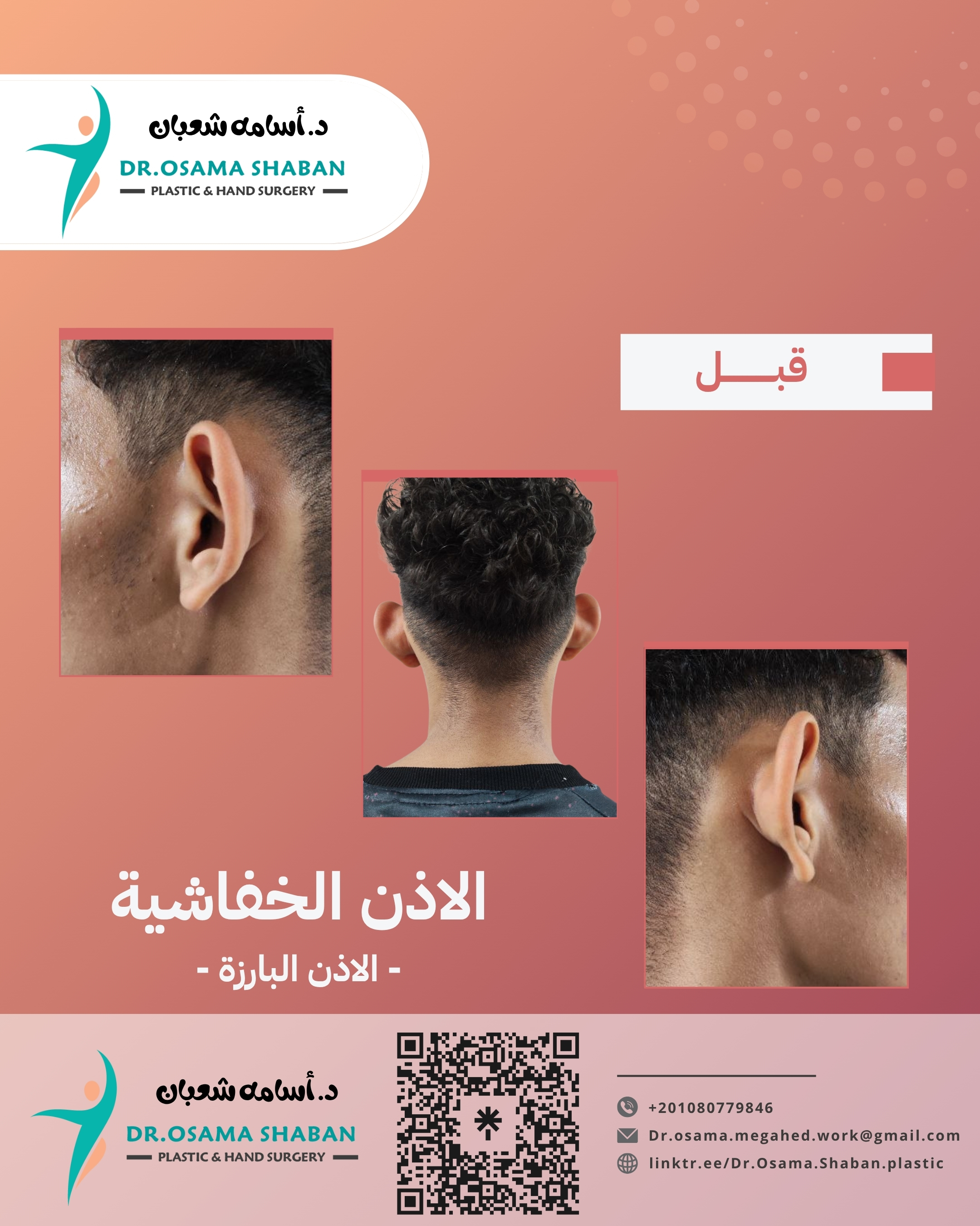 قبل العملية - اصلاح الاذن الخفاشية البارزة قبل - بعد