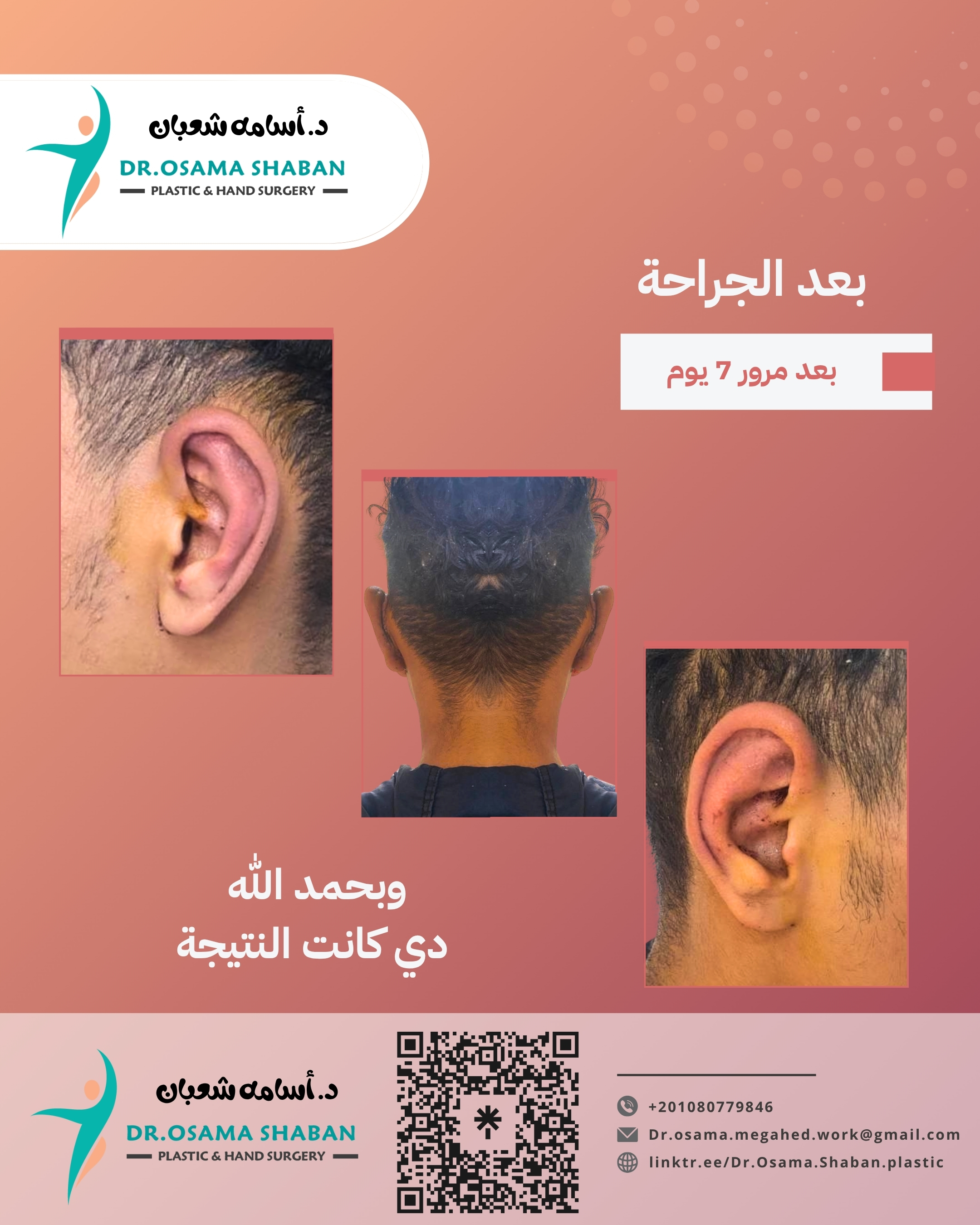 بعد العملية - اصلاح الاذن الخفاشية البارزة قبل - بعد